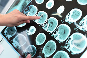 First In The World: Injecting Stem Cells Directly Into the Brain for Alzheimer's Disease! (Zoom)